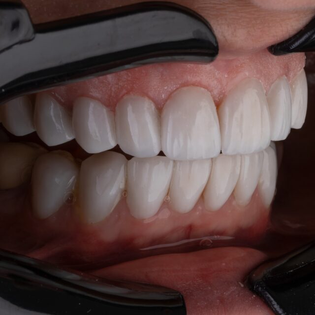 Professional Teeth Whitening Treatment